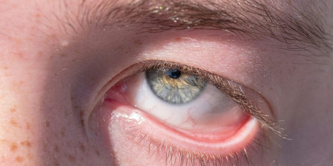 Conjuntivitis en verano: cómo evitar esta inflamación ocular en temporada de calor, según una oftalmóloga