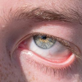 Conjuntivitis en verano: cómo evitar esta inflamación ocular en temporada de calor, según una oftalmóloga