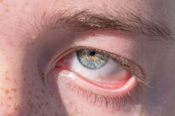 Conjuntivitis en verano: cómo evitar esta inflamación ocular en temporada de calor, según una oftalmóloga