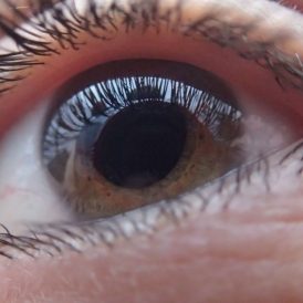 Cuál es la enfermedad tiroidea que afecta la salud de los ojos y cómo reconocer sus señales de alerta